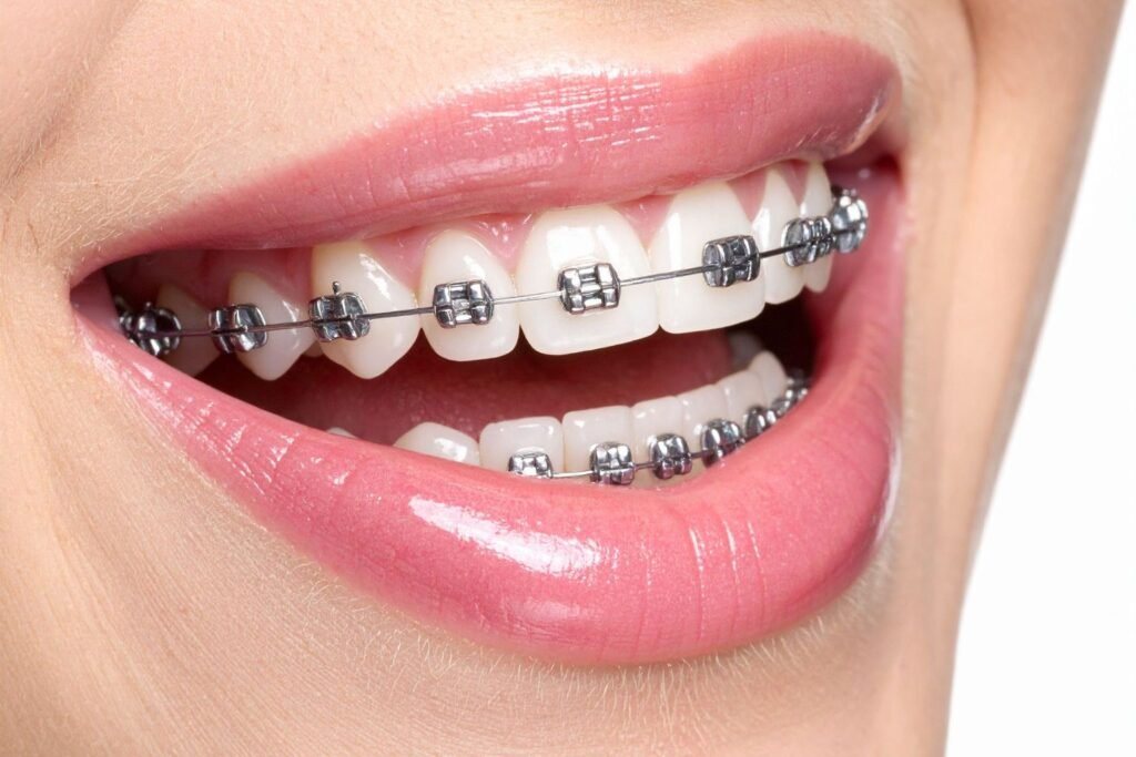 Traditional Metal Braces