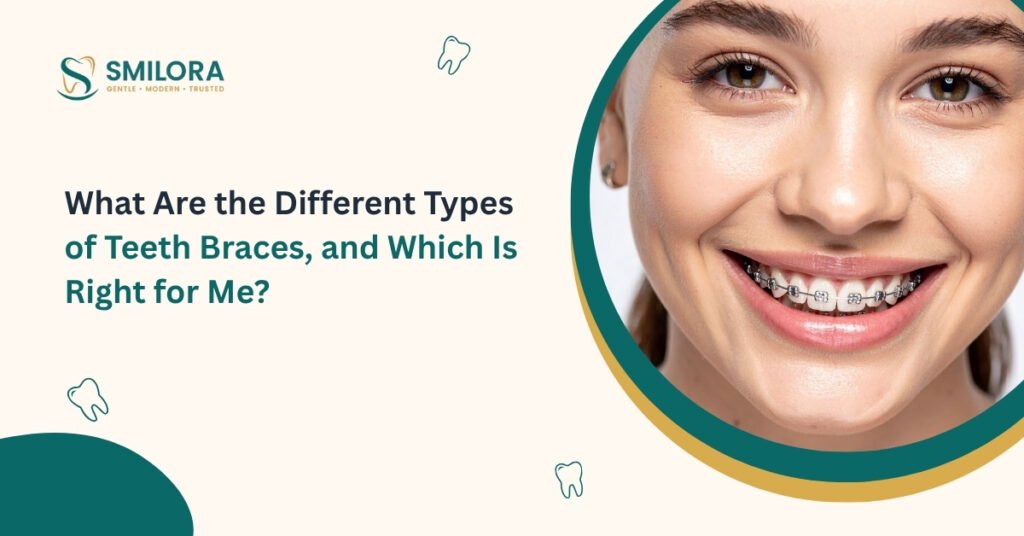 What Are the Different Types of Teeth Braces, and Which Is Right for Me