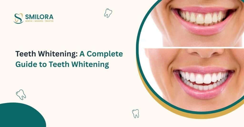 A Complete Guide to Teeth Whitening