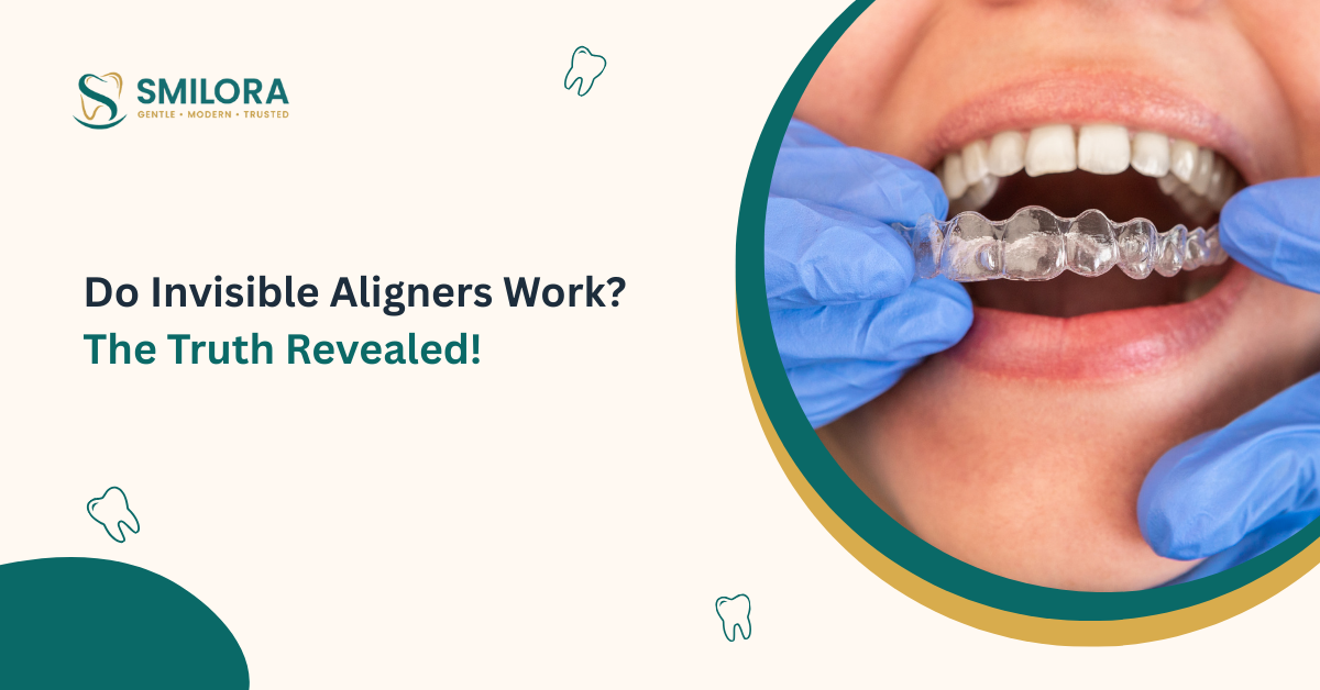 Do Invisible Aligners Work The Truth Revealed!