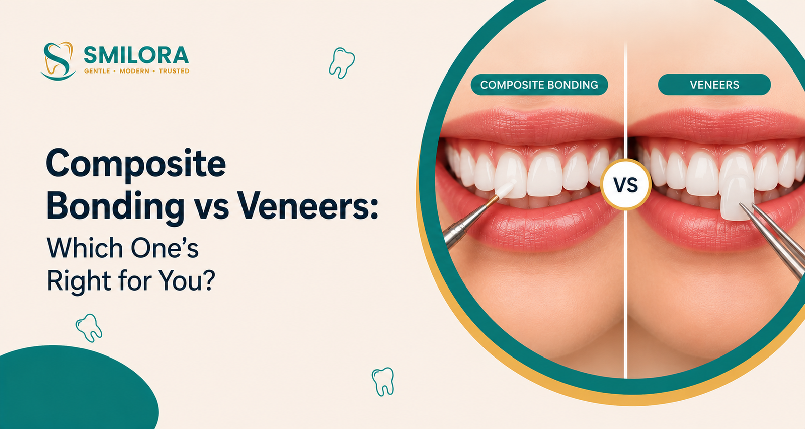 Composite bonding vs veneers smile comparison