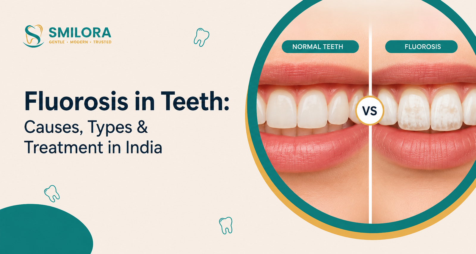 Fluorosis in teeth infographic showing normal teeth vs fluorosis-stained teeth, highlighting causes, types, and treatment options in India.
