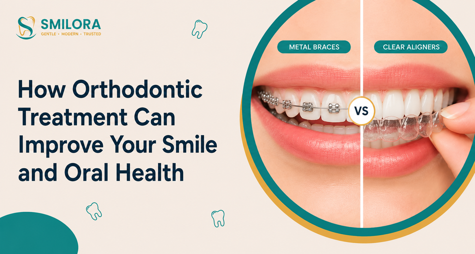 Orthodontic treatment with braces and clear aligners