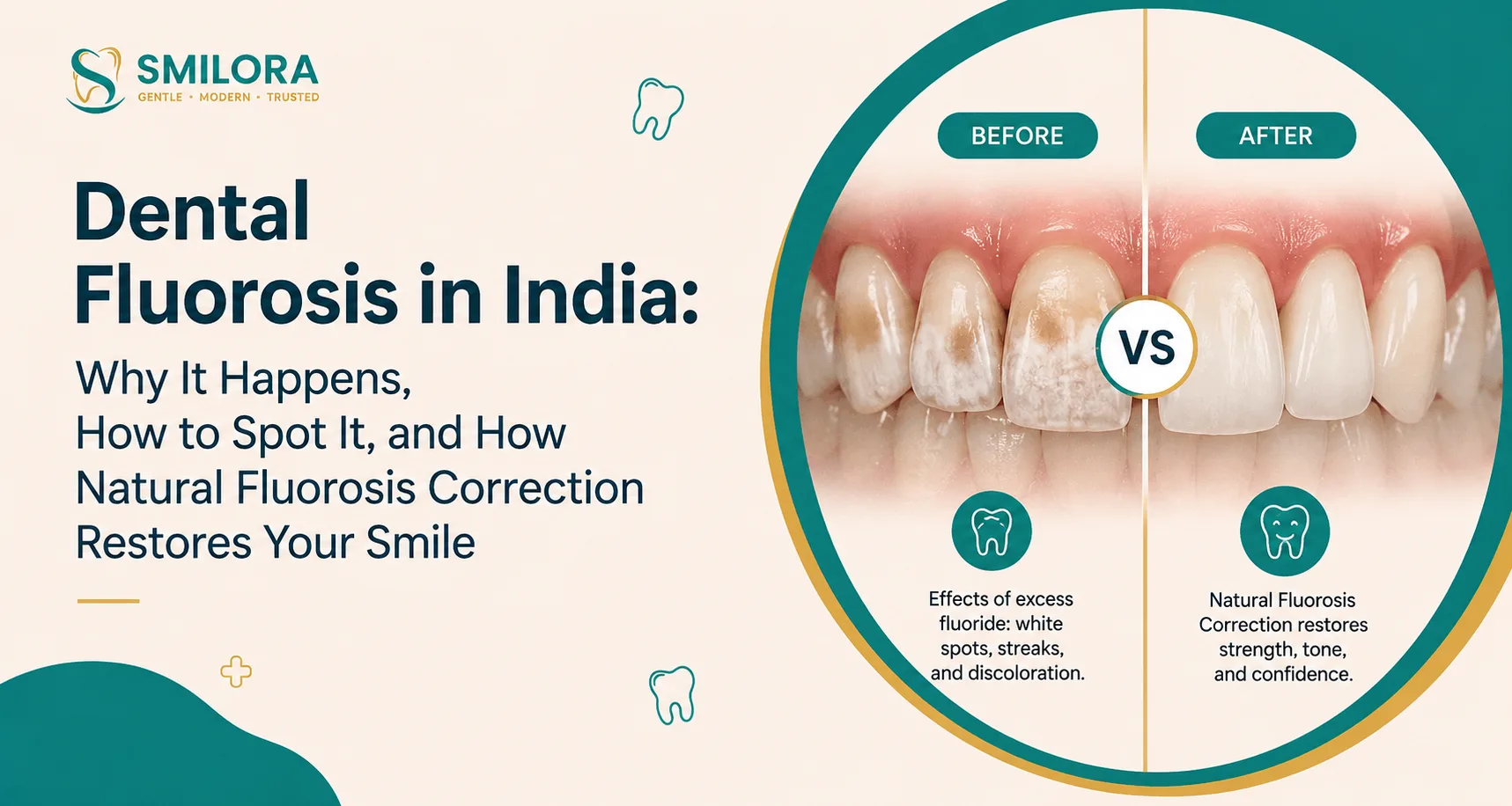 Dental fluorosis in India before and after teeth comparison with natural fluorosis correction and smile restoration.