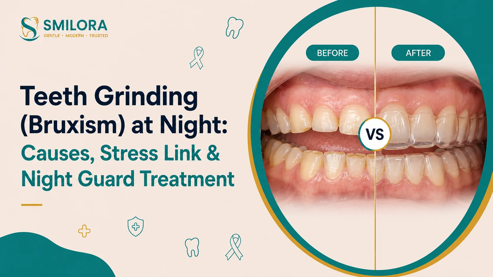 Teeth grinding (bruxism) at night showing worn teeth before treatment and a protective night guard for bruxism relief.