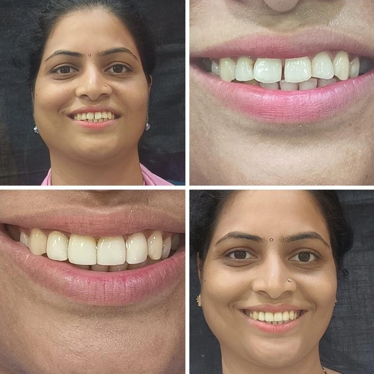 Veneers Smile designing Veneers Smile designing