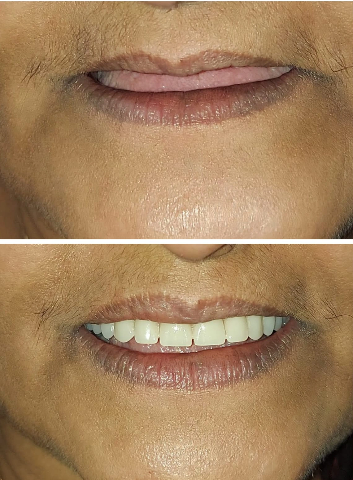 Complete Dentures Complete Dentures