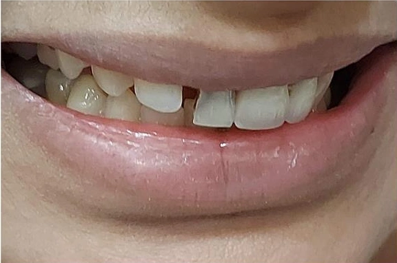 Before Before