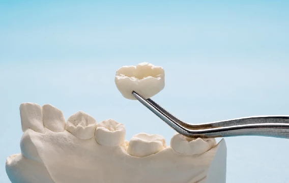 Dental Crowns & Bridges in Chembur Dental Crowns & Bridges in Chembur