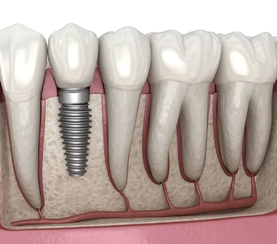 Dental Implant in Chembur Dental Implant in Chembur