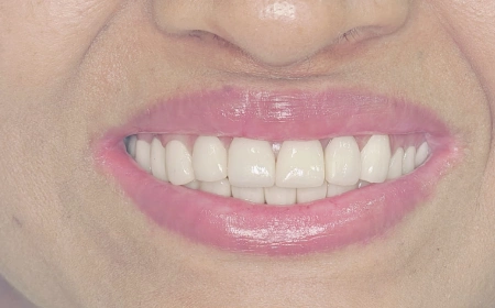 After Full-Mouth Rehabilitation After Full-Mouth Rehabilitation