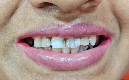 Before Full-Mouth Rehabilitation Before Full-Mouth Rehabilitation