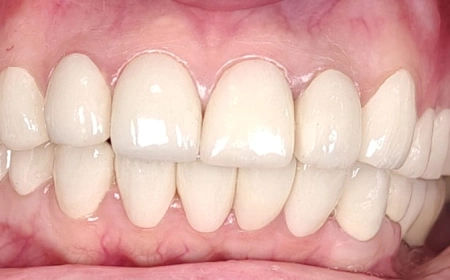 After Full-Mouth Rehabilitation After Full-Mouth Rehabilitation