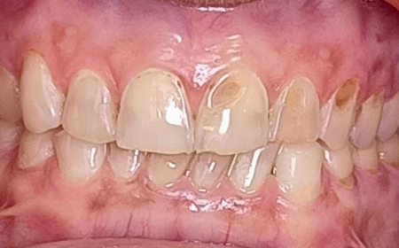 Before Full-Mouth Rehabilitation Before Full-Mouth Rehabilitation