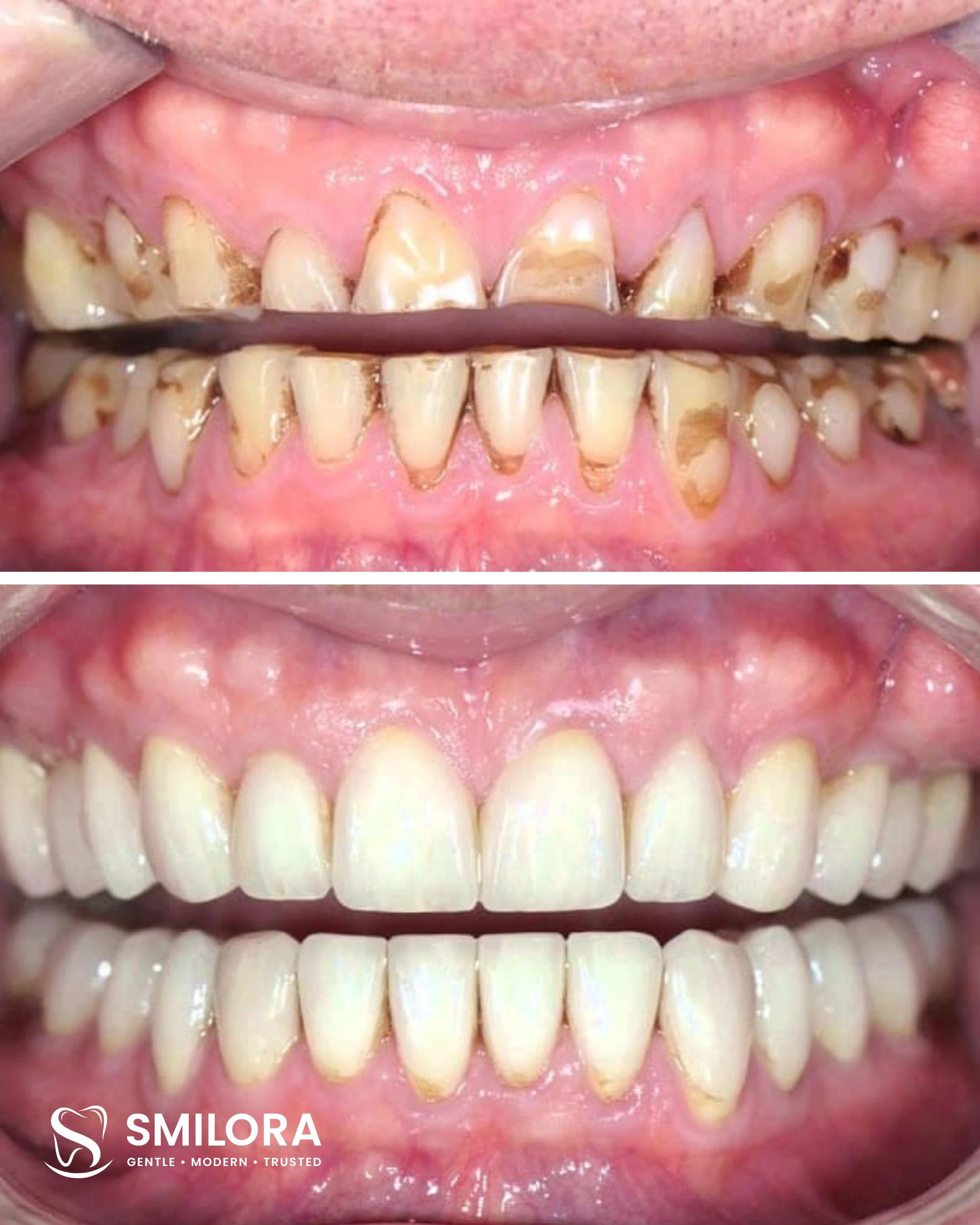 Full Mouth Rehabilitation Transformation
