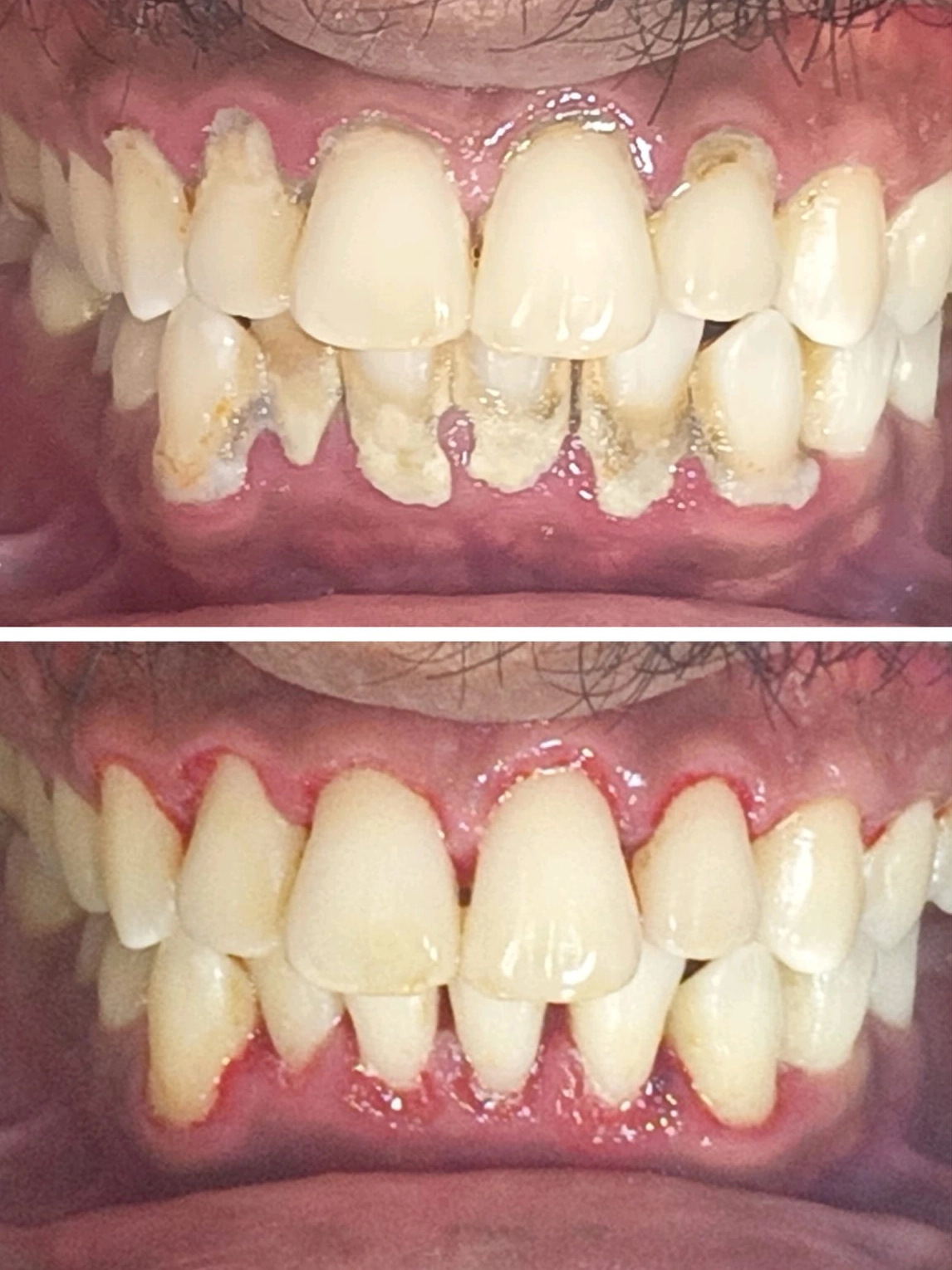 Dental Cleaning - General Desntistry Dental Cleaning - General Desntistry