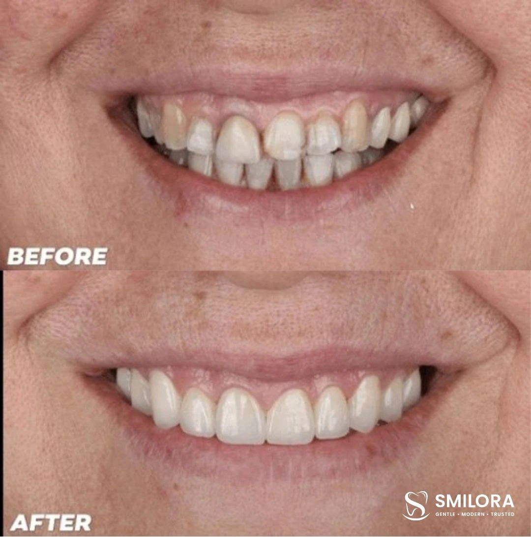 Natural Teeth Alignment Transformation