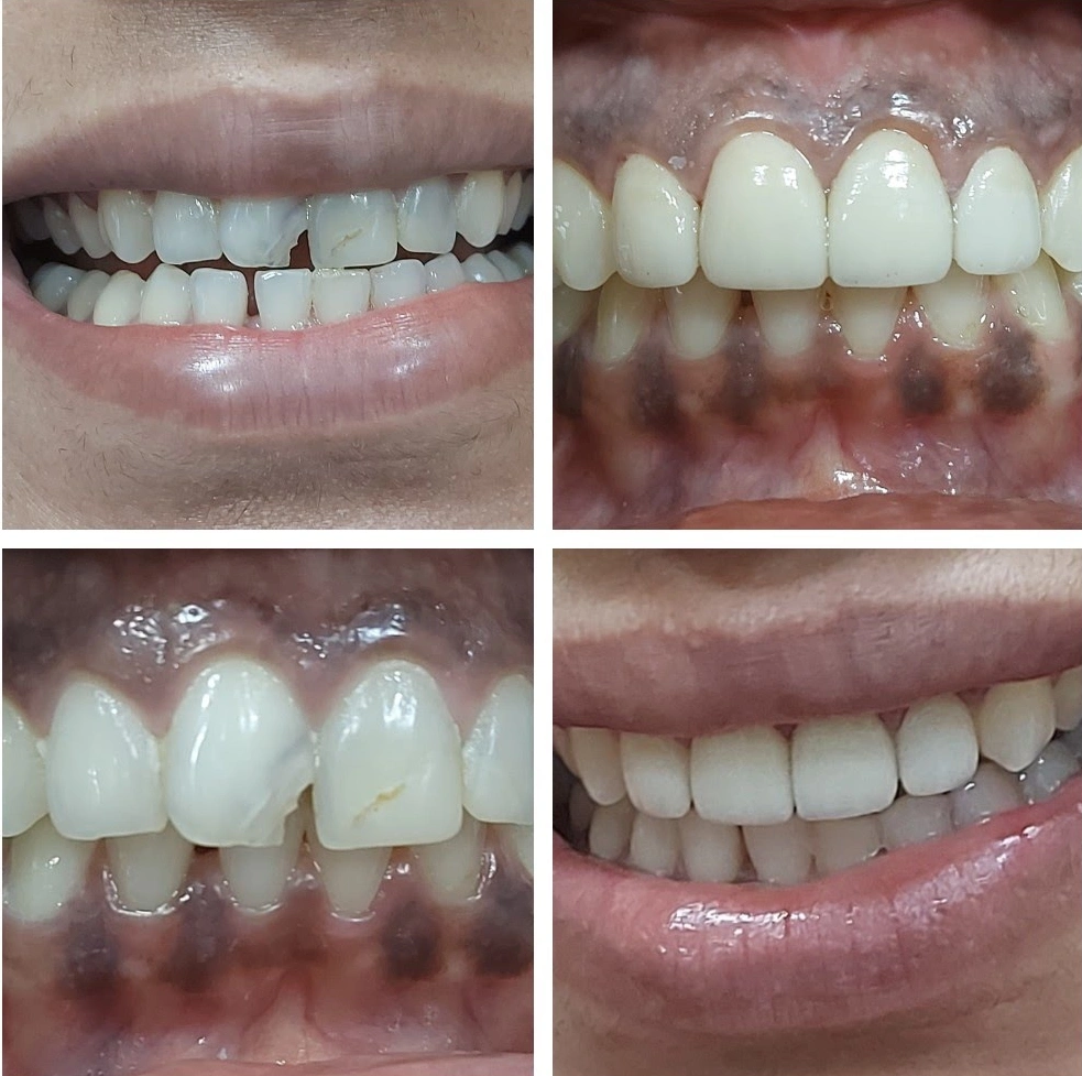 Smile designing - Dental Crowns Smile designing - Dental Crowns