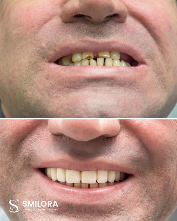 SNatural Smile Transformation