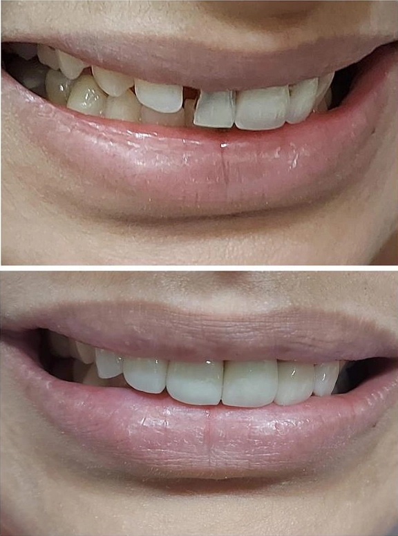 Smile designing with dental crowns Smile designing with dental crowns