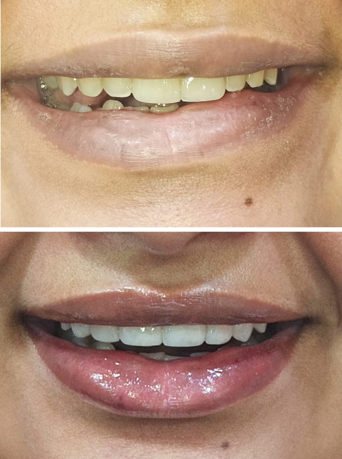 Dental Veneers Dental Veneers
